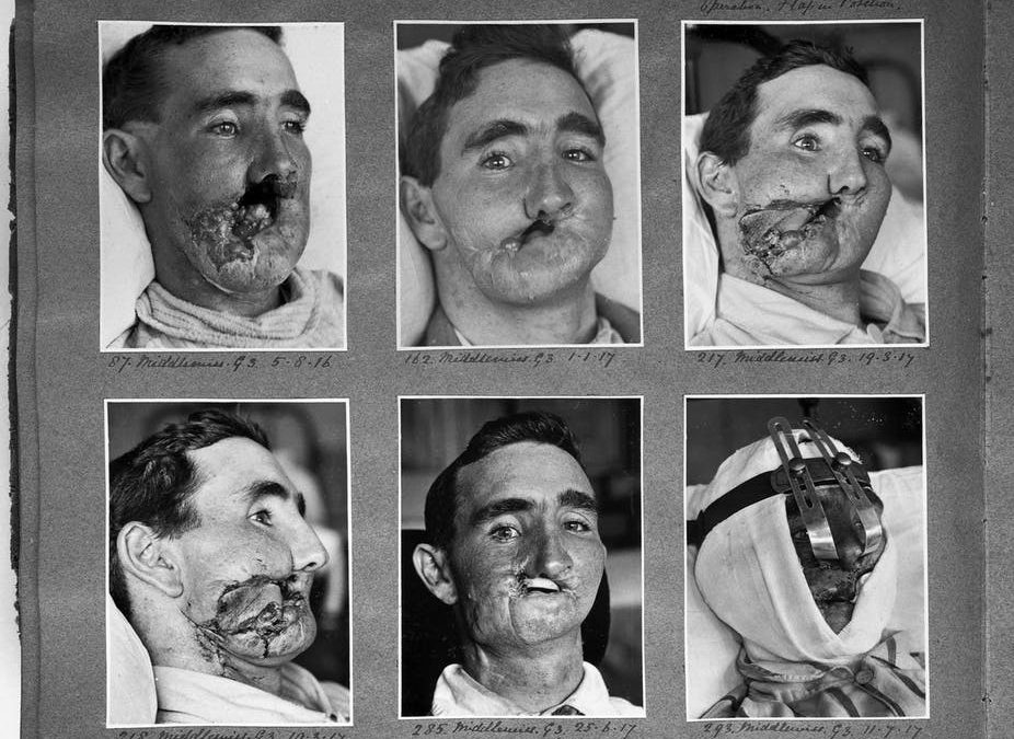 World War I: the birth of plastic surgery and modern anaesthesia